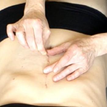 Rolﬁng® and Scars